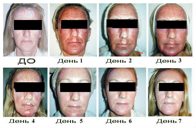 Холодная плазма для лица фото до и после в косметологии
